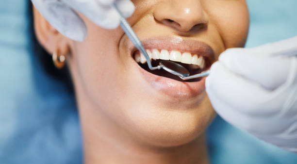 Best Knocked-Out Tooth (Avulsed Tooth) Treatment in Lamont, MI